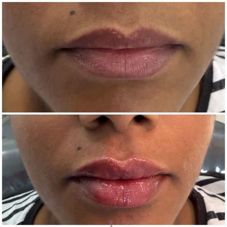 Antes e depois de preenchimento labial